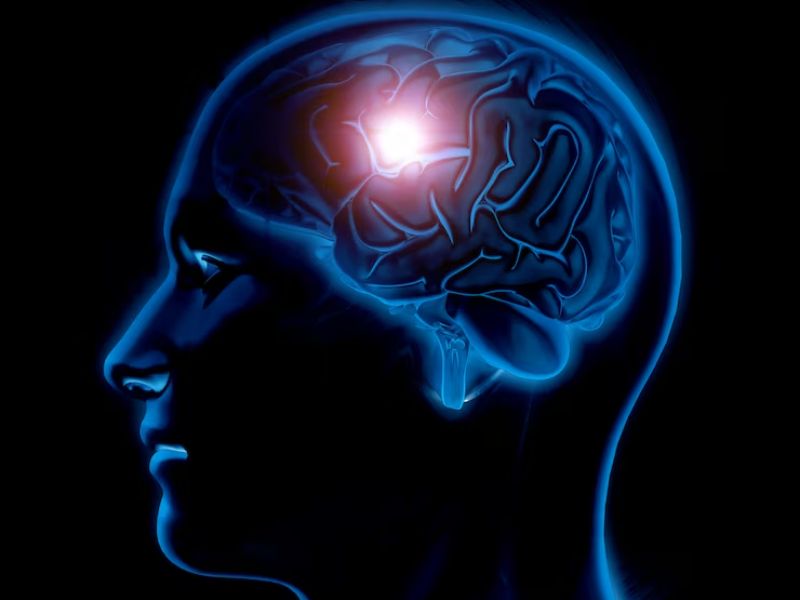 SclÃ©rose en plaque