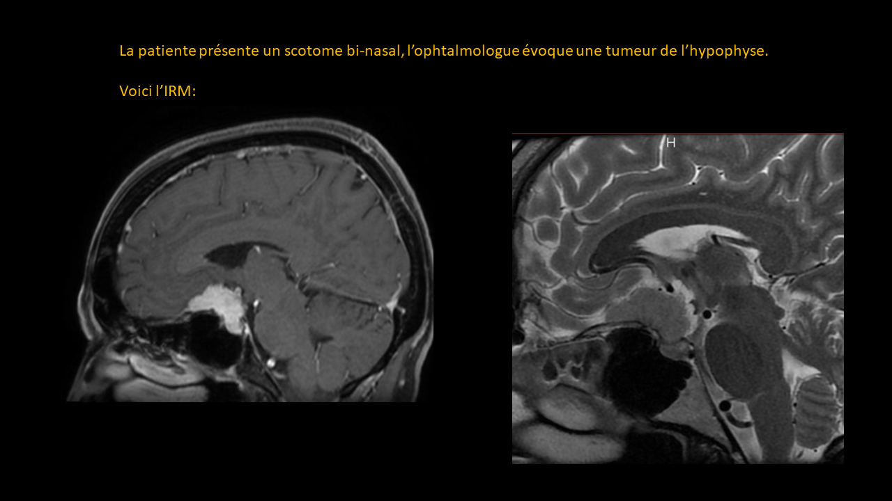 Question MÃ©ningiome