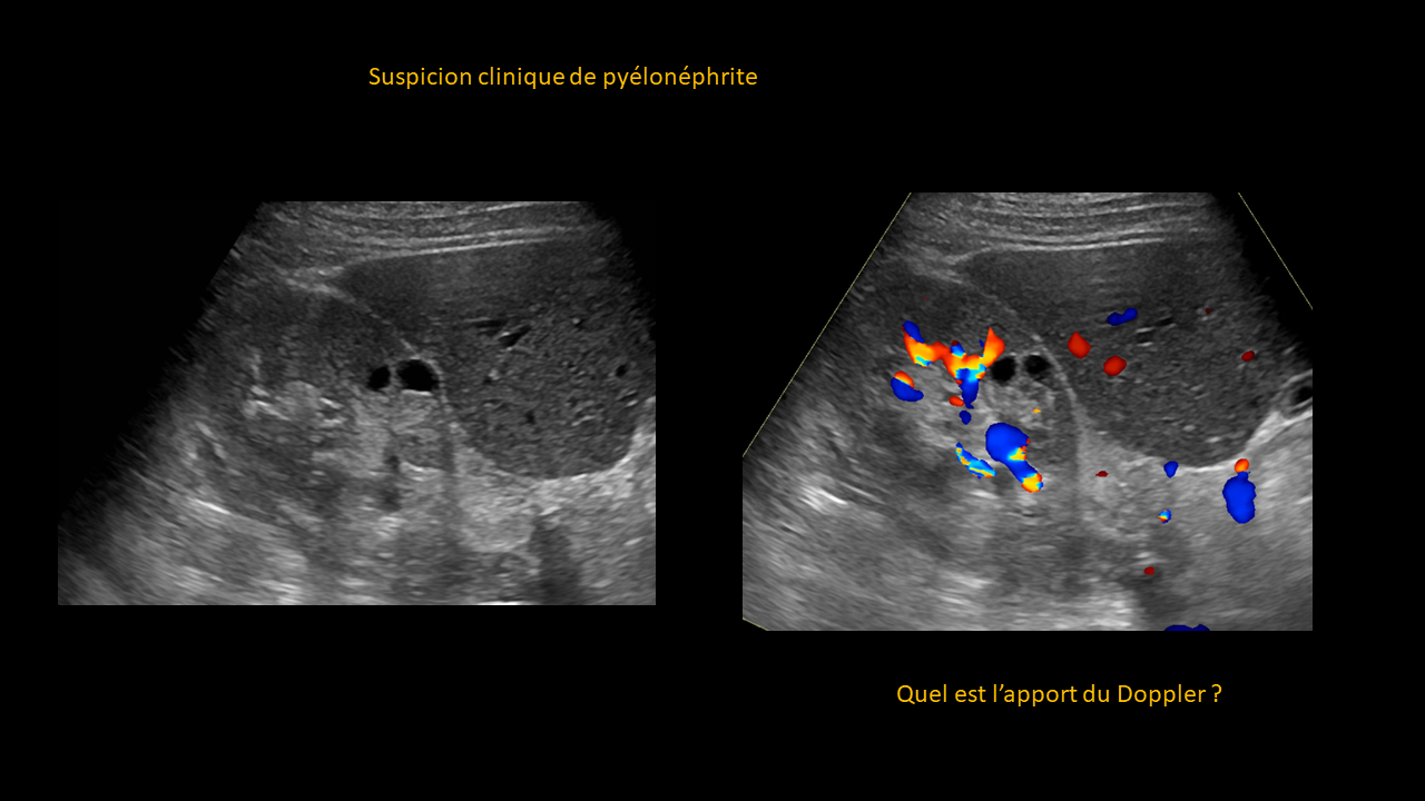Question PyÃ©lonÃ©phrite