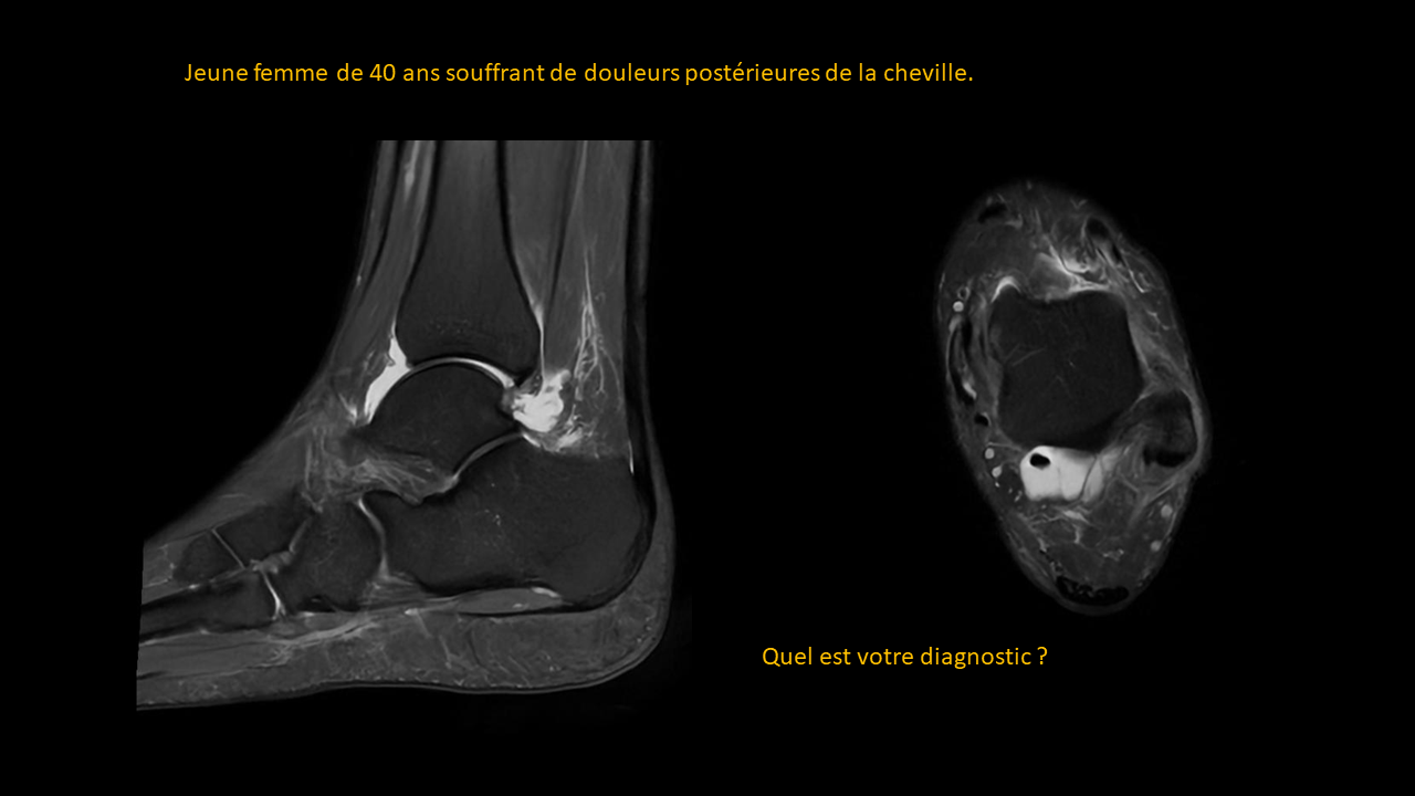 Question TÃ©nosynovite