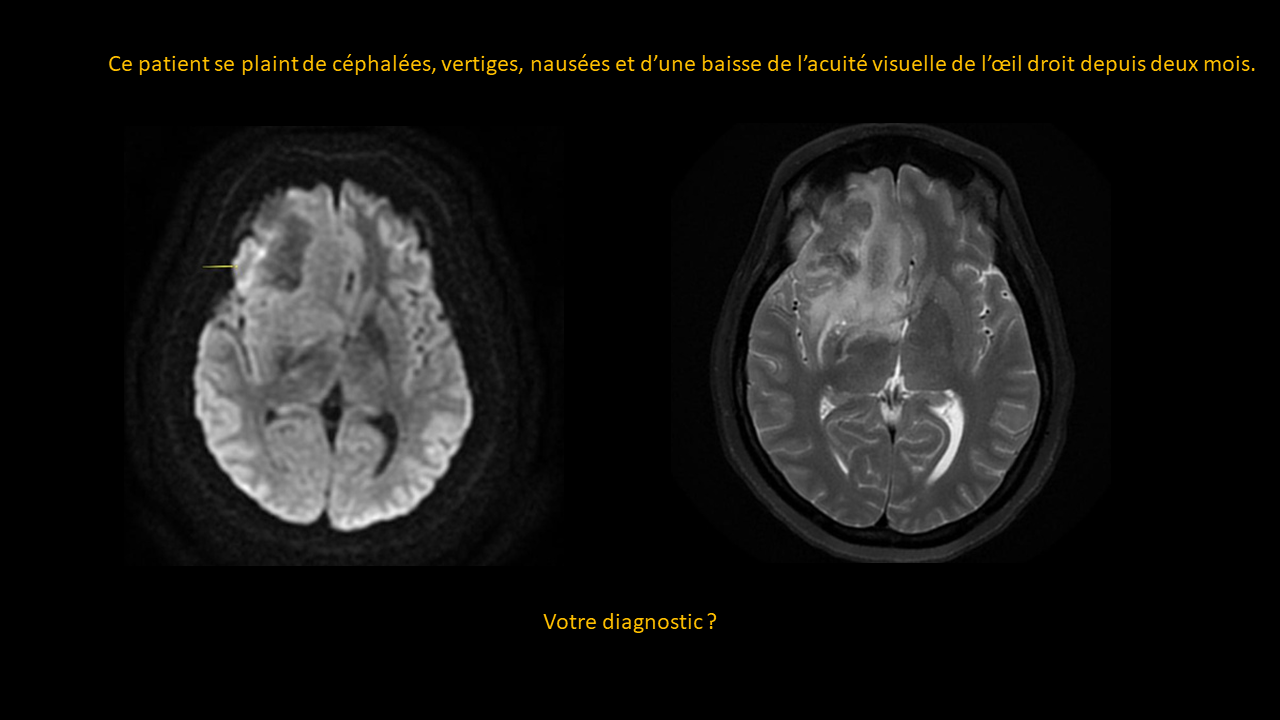 Question mycobactÃ©rium